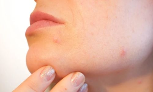 «ковидные пальцы» и сыпь: исследователи назвали шесть кожных симптомов «омикрона»
